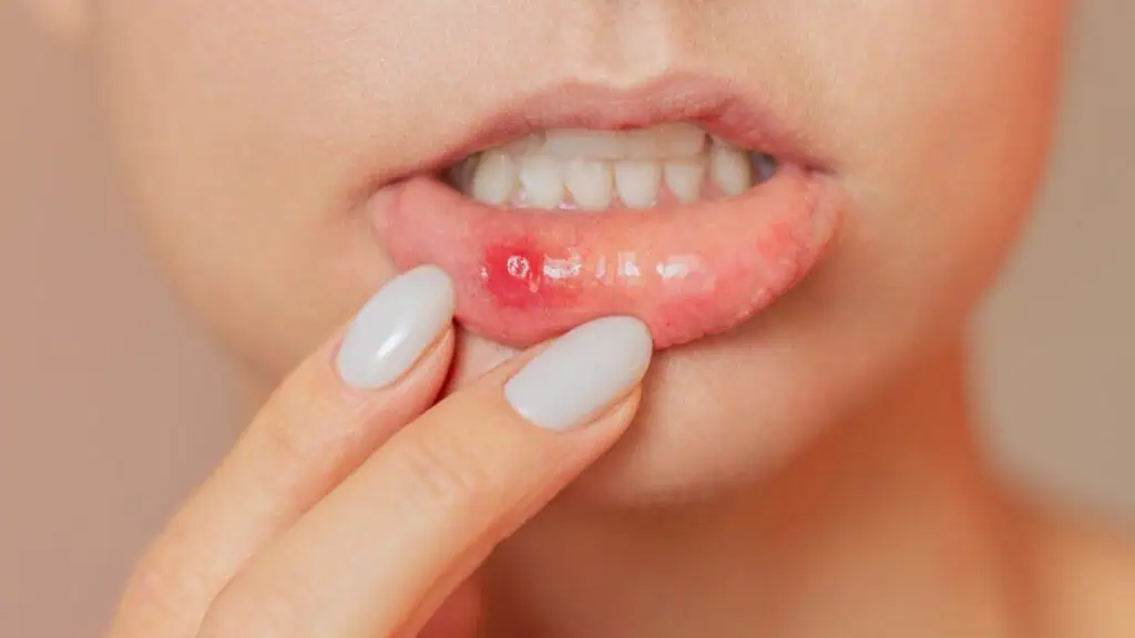 Glossitis and Mouth Ulcers