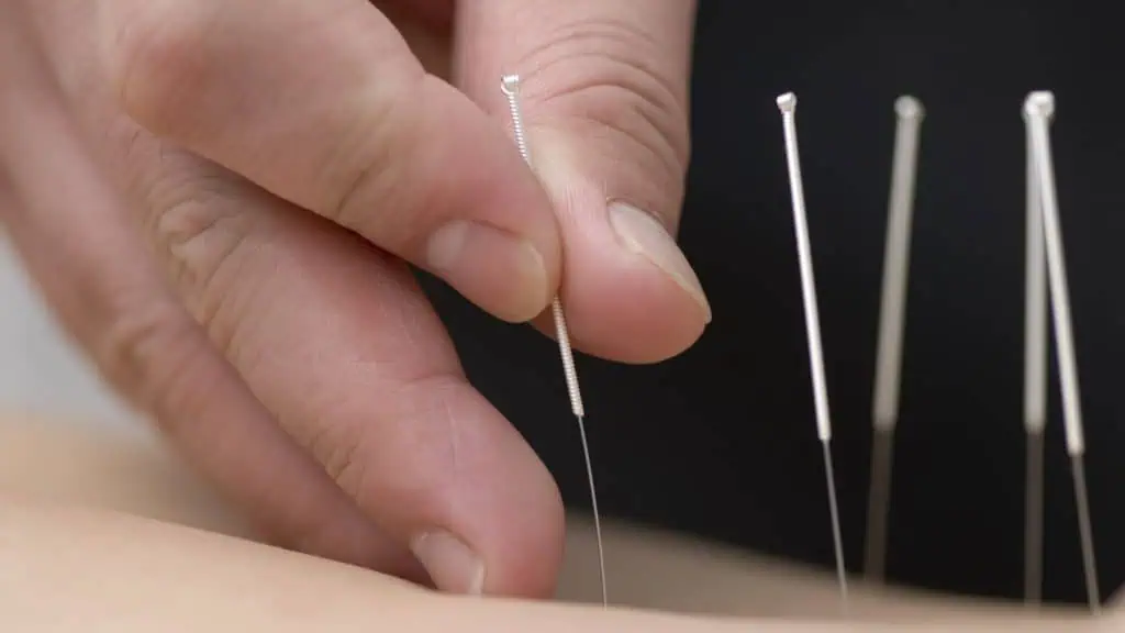 Acupuncture